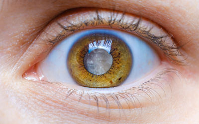 Exploring Cataract Surgery Lens Replacement Options